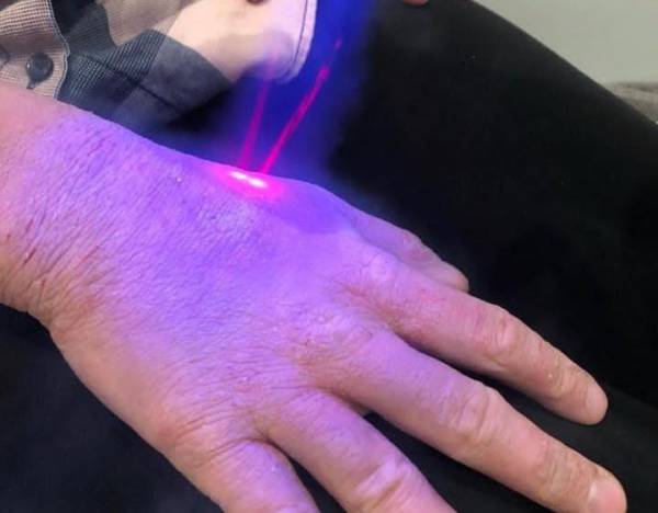 Operasi Cryotherapy, Bedan Medis dengan Nitrogen Cair untuk Kulit (Sumber : Instagram/@essexcryowellness)