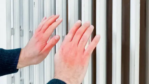 Frostbite menjadi salah satu masalah kesehatan yang diakibatkan paparan suhu dingin | Foto: iStock