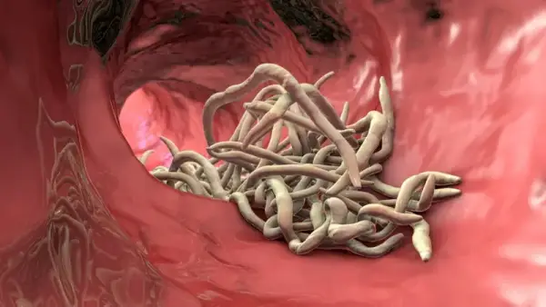 Ilustrasi infeksi cacing gelang (Ascariasis) di usus manusia. (Sumber Foto: Icloudehospital)
