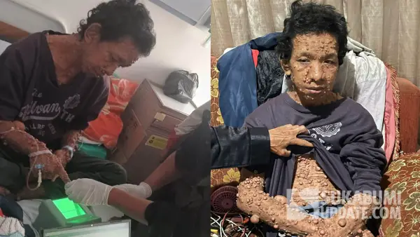 Abdurohman (40 tahun) warga Benteng Kota Sukabumi mengidap penyakit kulit langka | Foto : Asep Awaludin