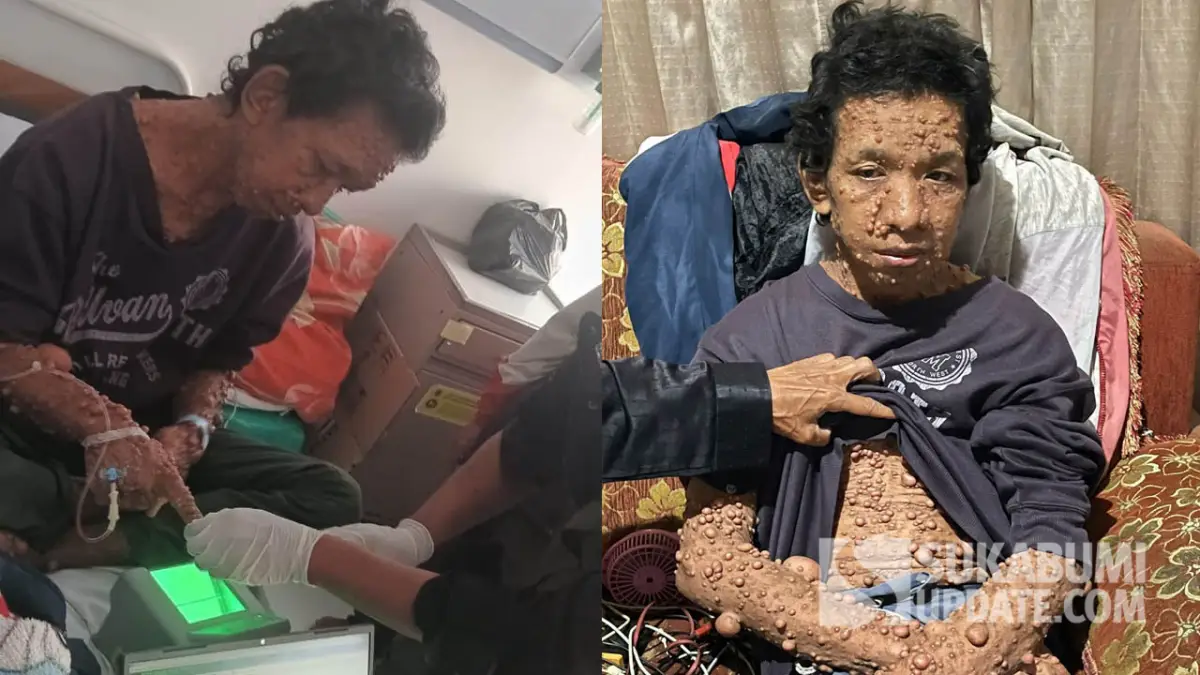 Abdurohman Warga Benteng Kota Sukabumi Derita Neurofibromatosis, Penyakit Kulit Langka