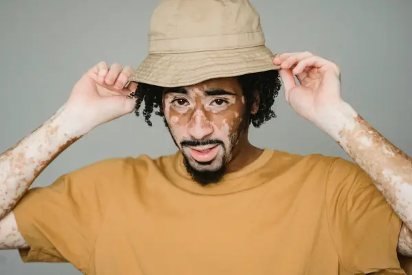 Ilustrasi mengenal vitiligo, penyakit kulit yang mengubah warna bukan tekstur (Sumber: pexels.com/@Armin Rimoldi