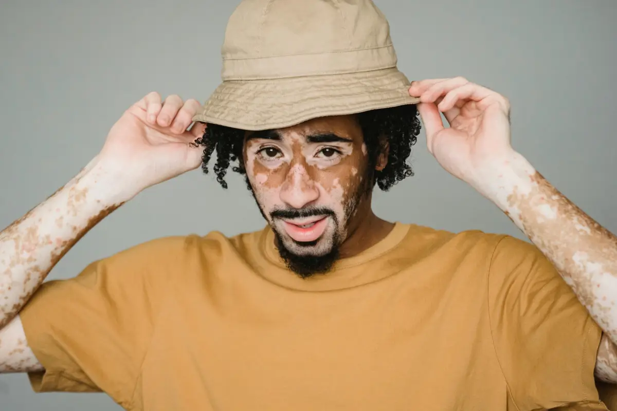 Mengenal Vitiligo: Penyakit Kulit yang Mengubah Warna, Bukan Tekstur