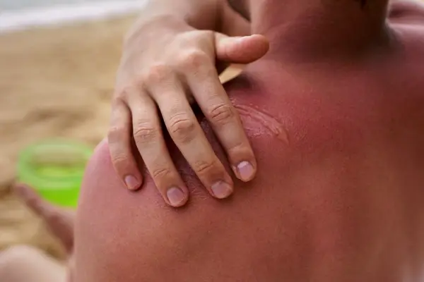 Ilustrasi Sunburn, 5 Bahan Alami yang Bisa Menenangkan Kulit Terbakar Matahari (Sumber : Freepik)