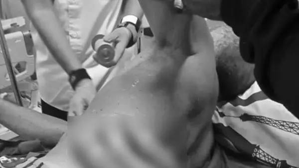 Kondisi lansia di Surade Sukabumi, saat mendapat penanganan medis setelah mengalami luka parah akibat tertusuk bambu yang ditebangnya sendiri. (Sumber : Istimewa)