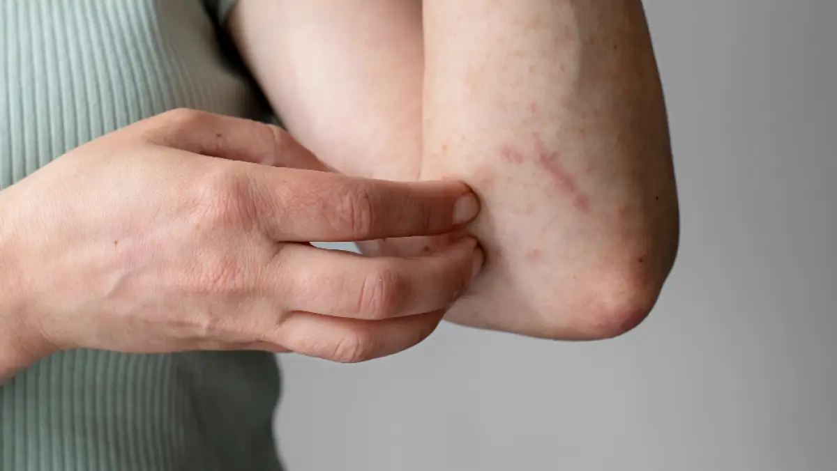 Mengapa Gatal-Bentol Muncul Pada Malam Hari? Ini Penyebab dan Cara Mengatasinya