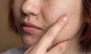 Ilustrasi kulit wajah yang mengalami masalah bruntusan (Sumber : Freepik)