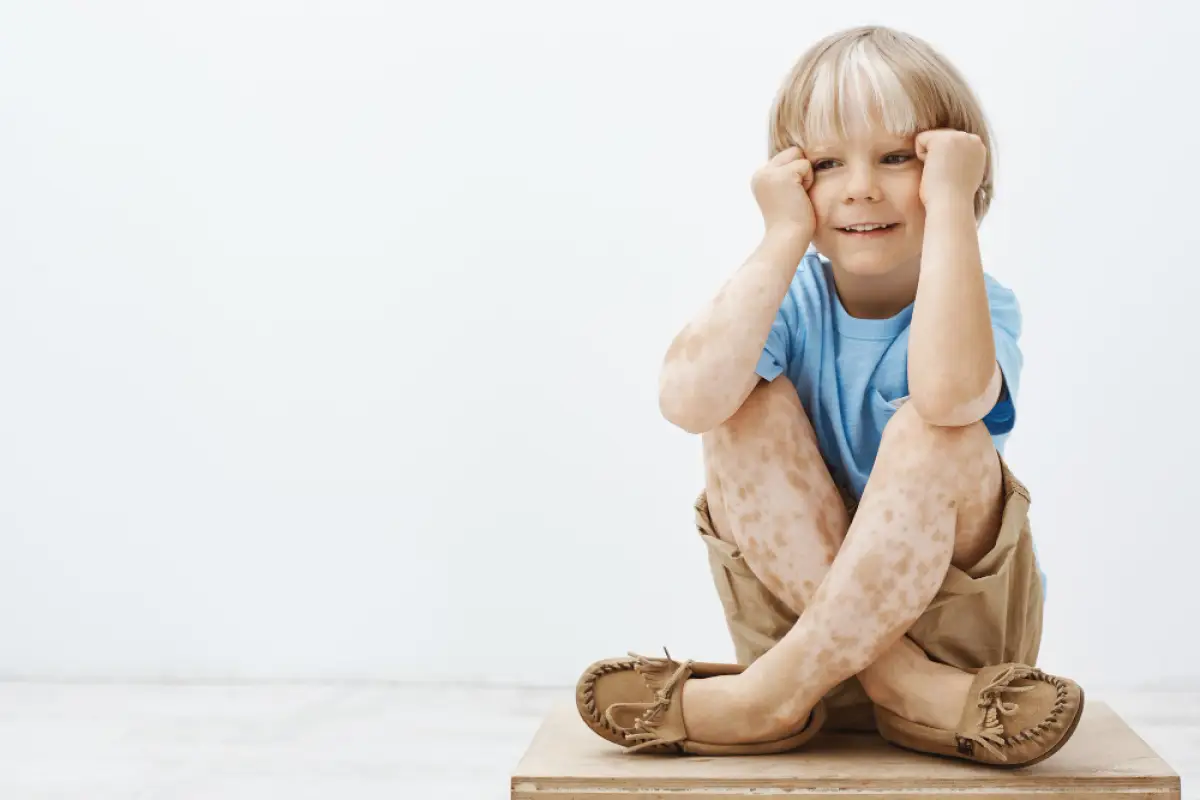 Vitiligo pada Anak: Penyebab, Gejala, dan Cara Mendukung Kepercayaan Diri Anak