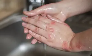 Ilustrasi cara mengatasi luka bakar kimia akibat air keras (Sumber : Freepik)