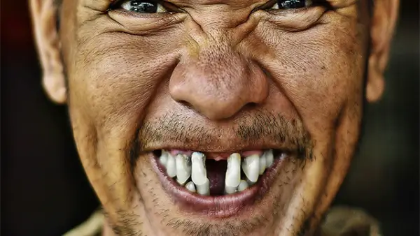 Ilustrasi gigi bolong. (Sumber : pexels.com/@SweeMing YOUNG).