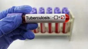 Kasus Tuberculosis (TBC) di wilayah Kota Sukabumi | Foto : Ilustrasi Pixabay