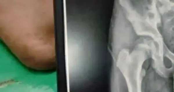 Patah tulang tertutup foto ronsen pelajar korban bullying di Nagrak Kabupaten Sukabumi (Sumber : dok keluarga)