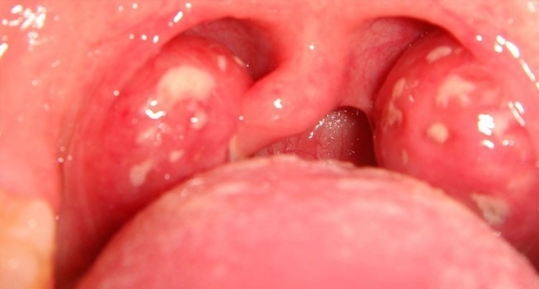 Wabah Difteri Jadi Kejadian Luar Biasa, Dinkes Kabupaten Sukabumi Lakukan Ini