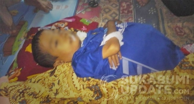 Empat Tuntutan Somasi Soal Anak Busung Lapar di Kabupaten Sukabumi