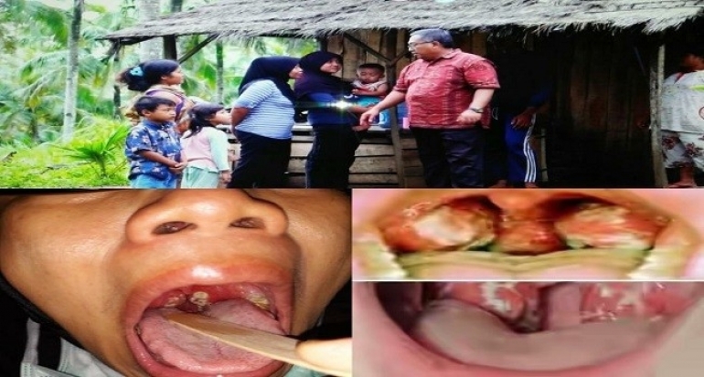 Waspadai Difteri, Bupati Sukabumi Minta Dinkes Lakukan Antisipasi